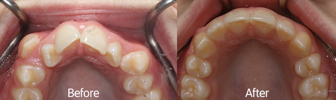 Before And After - Smile Gallery - Plaza Dental Group