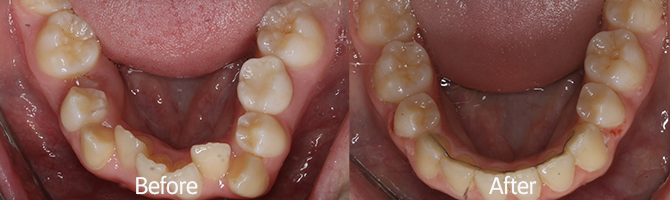 Before And After - Smile Gallery - Plaza Dental Group